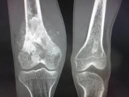 bone cancer
